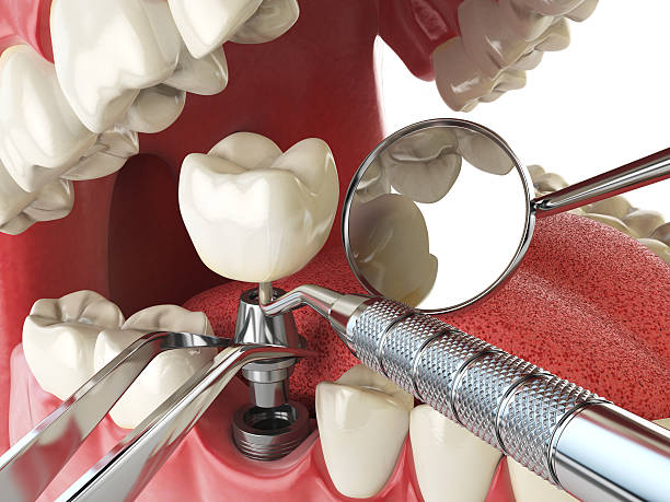Best Emergency Root Canal Treatment in Horseshoe Bend, AR